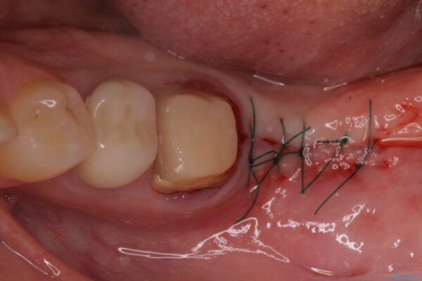 痛みを感じる奥歯　根管治療とインプラント治療 治療途中画像