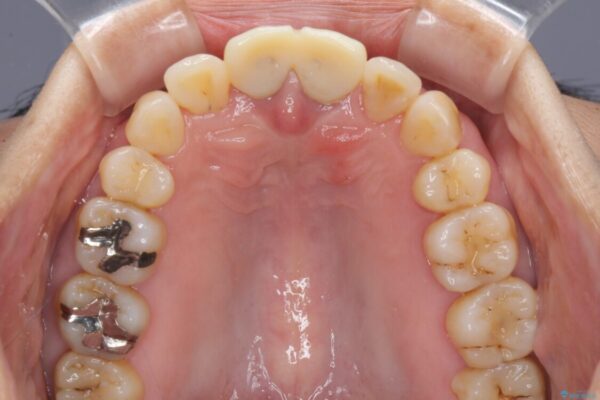部分矯正とセラミック　前歯の審美治療 治療途中画像