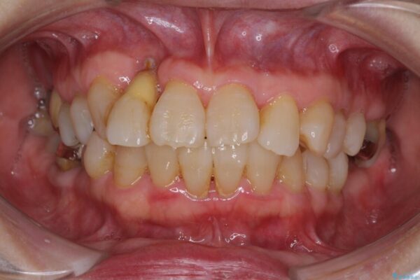 歯周病改善のための総合歯科治療 治療前画像