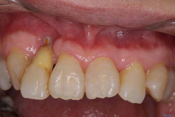歯周病改善のための総合歯科治療 治療前画像