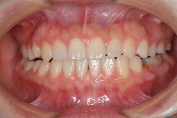 隙間の空いた前歯を治したい　インビザライン矯正治療 治療途中画像