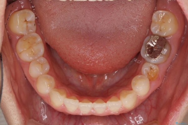 隙間の空いた前歯を治したい　インビザライン矯正治療 治療途中画像