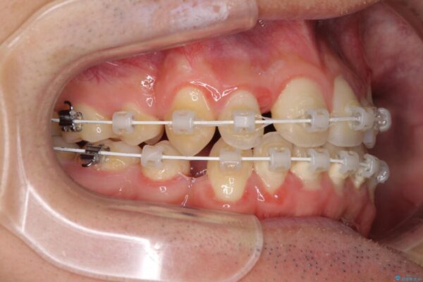 八重歯を治したい　目立たないワイヤー装置での抜歯矯正 治療途中画像