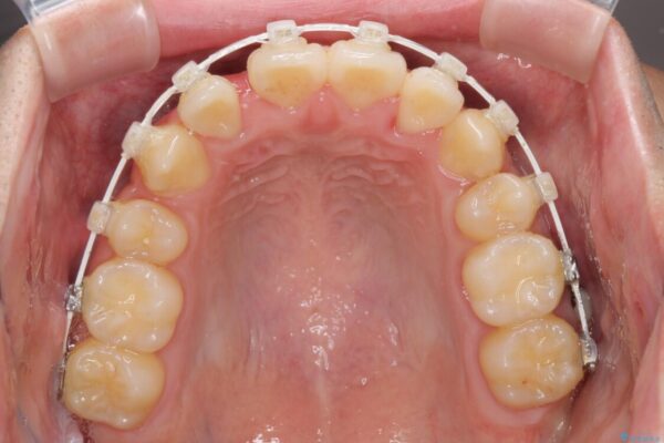 八重歯を治したい　目立たないワイヤー装置での抜歯矯正 治療途中画像