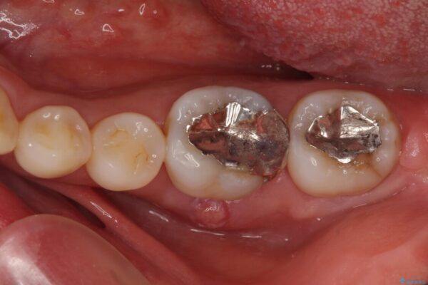 奥歯の虫歯　オールセラミッククラウンによる補綴治療 治療前画像