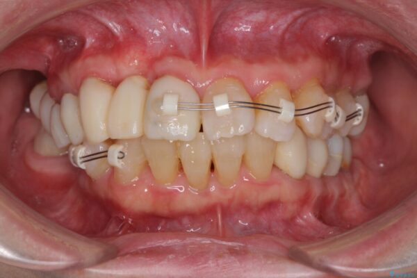 歯周病改善のための総合歯科治療 治療途中画像