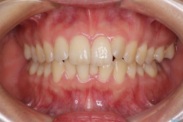 前歯のデコボコを解消　インビザラインによる矯正治療 ビフォー