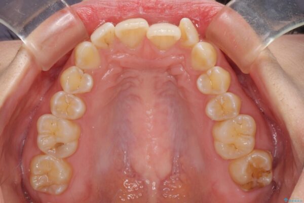 前歯のデコボコを解消　インビザラインによる矯正治療 治療前画像