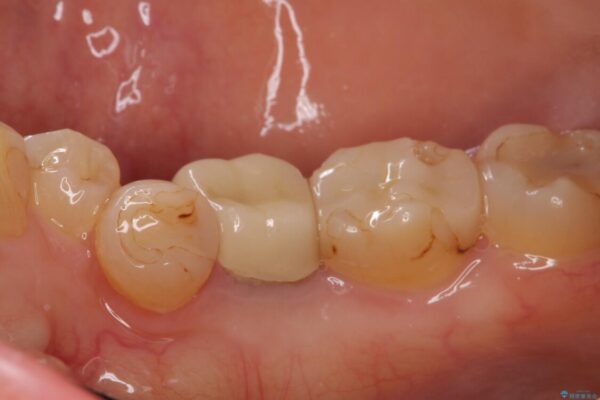 痛みを感じる奥歯　根管治療とインプラント治療 治療前画像