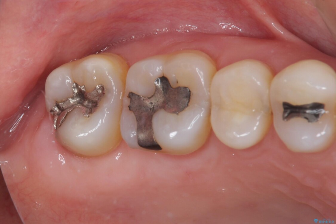 奥歯の虫歯　ゴールドインレーによる修復治療 治療前