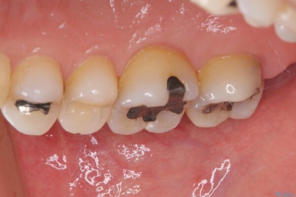 奥歯の虫歯　ゴールドインレーによる修復治療 治療前画像