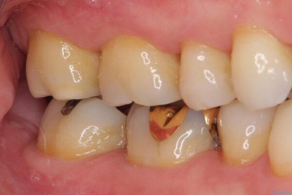奥歯の虫歯　ゴールドインレーによる修復治療 治療前画像