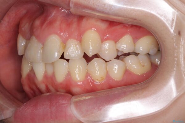 狭い上顎骨を拡大　インビザラインによる非抜歯矯正 治療前画像