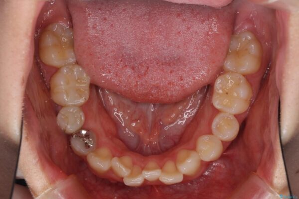 狭い上顎骨を拡大　インビザラインによる非抜歯矯正 治療前画像