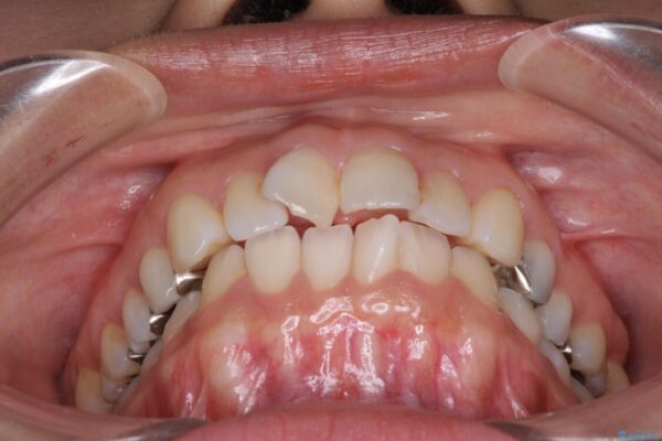 前歯の突出を軽減　インビザラインによる抜歯矯正 治療前画像