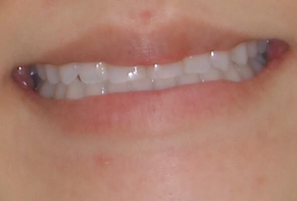 前歯のクロスバイトを治したい　インビザラインによる矯正治療 治療後画像
