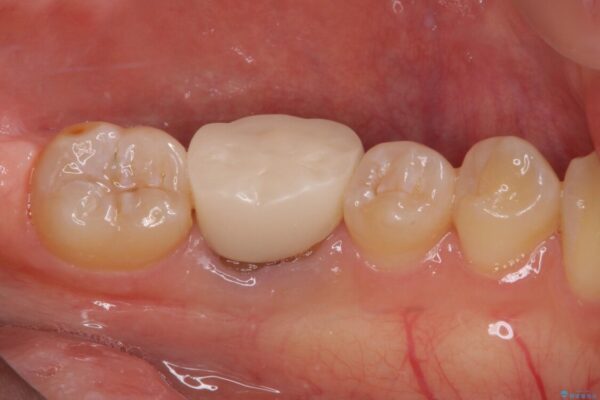 形が気に入らない　奥歯のオールセラミッククラウン 治療前画像
