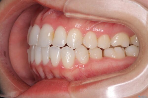 前歯のクロスバイトを治したい　インビザラインによる矯正治療 治療途中画像
