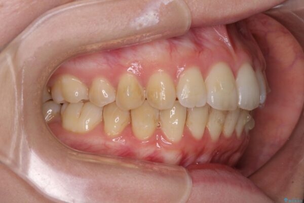 前歯のデコボコを解消　インビザラインによる矯正治療 治療途中画像