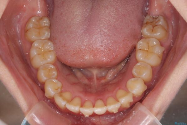前歯のデコボコを解消　インビザラインによる矯正治療 治療途中画像