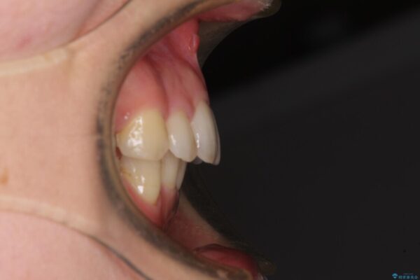 閉じにくい口元　前歯を引っ込める抜歯矯正 治療後画像
