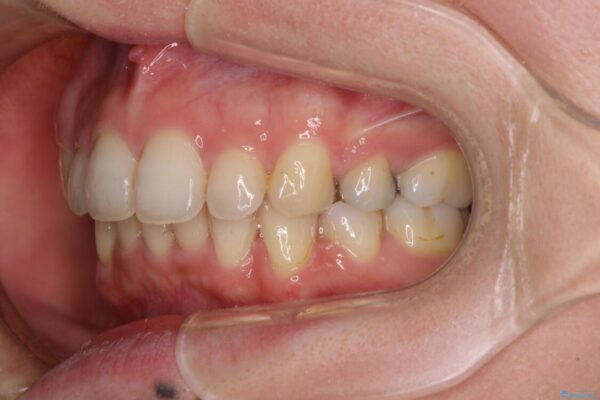 閉じにくい口元　前歯を引っ込める抜歯矯正 治療後画像