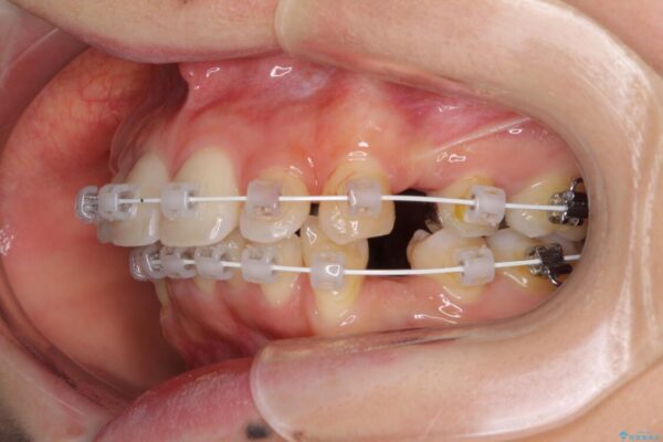 閉じにくい口元　前歯を引っ込める抜歯矯正 治療途中画像