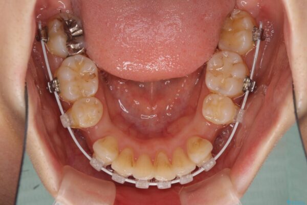 閉じにくい口元　前歯を引っ込める抜歯矯正 治療途中画像
