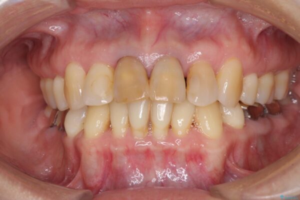 部分矯正とセラミック　前歯の審美治療 ビフォー