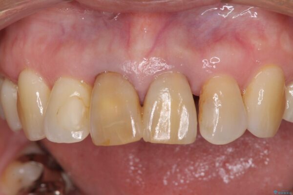 部分矯正とセラミック　前歯の審美治療 治療前画像