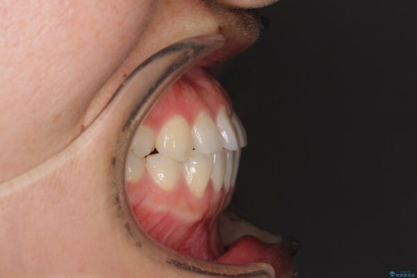 隙間の空いた前歯を治したい　インビザライン矯正治療 治療前画像