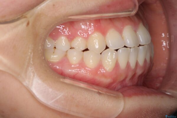 隙間の空いた前歯を治したい　インビザライン矯正治療 治療前画像