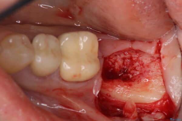 痛みを感じる奥歯　根管治療とインプラント治療 治療途中画像