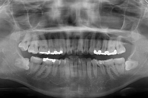 前歯の突出を軽減　インビザラインによる抜歯矯正 治療前画像