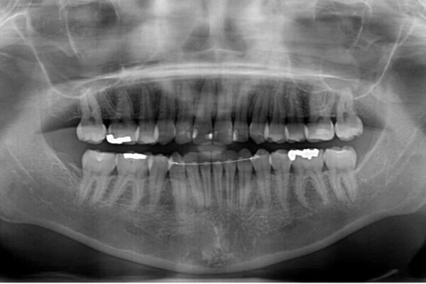 上下の八重歯を治したい　インビザラインと補助装置を用いた抜歯治療 治療後画像