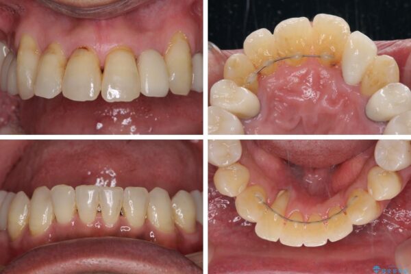 歯周病治療のための歯列矯正　総合歯科治療による全顎治療 治療後画像