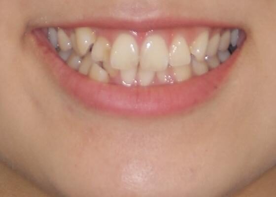 上下の八重歯を治したい　補助装置を用いたインビザライン矯正 治療前画像