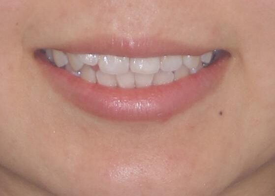 前歯のデコボコが気になる　インビザラインによる矯正治療 治療前画像