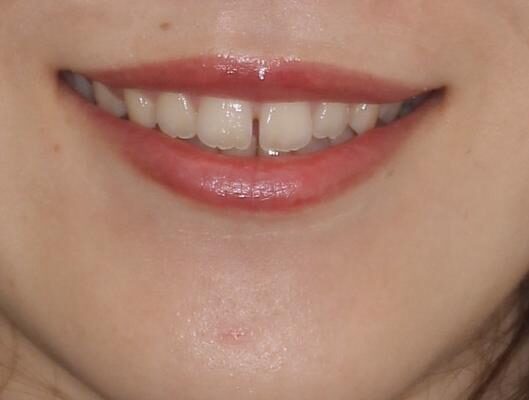気になる隙間の再矯正　前歯をインビザライン・ライトで改善 治療前画像