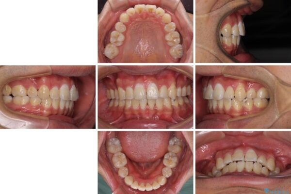 前歯の強いガタつきを解消　ワイヤー装置での抜歯矯正 治療後画像