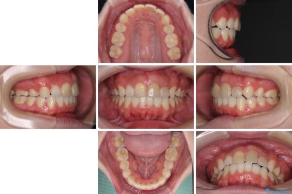 抜歯矯正の後戻り　インビザラインによるオープンバイトの再矯正 治療後画像