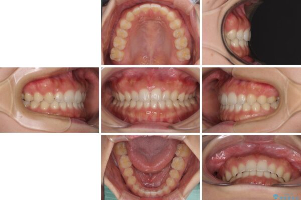 気になる隙間の再矯正　前歯をインビザライン・ライトで改善 治療後画像