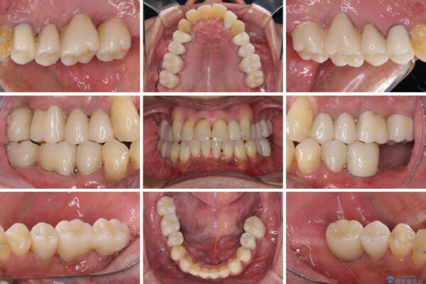 歯周病治療のための歯列矯正　総合歯科治療による全顎治療 治療後画像