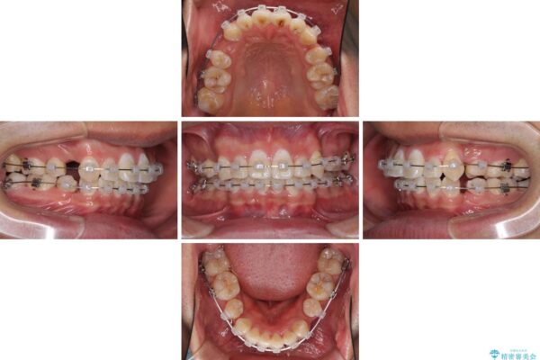 前歯の強いガタつきを解消　ワイヤー装置での抜歯矯正 治療途中画像