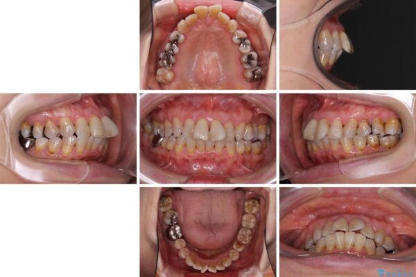 口元の閉じにくさを改善したい　ワイヤー装置での抜歯矯正 治療前画像