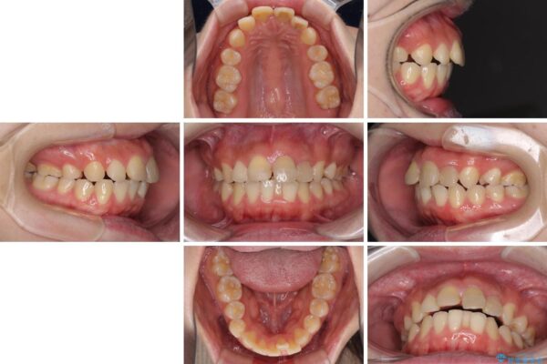 抜歯矯正の後戻り　インビザラインによるオープンバイトの再矯正 治療前画像