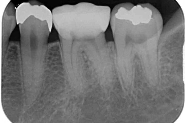 保険診療で装着した奥歯の白いクラウン　痛みが続くためセラミッククラウンへ 治療前画像