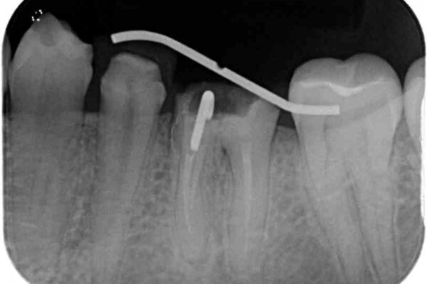 奥深くまでの虫歯で歯茎が腫れる　部分矯正を用いた治療 治療途中画像