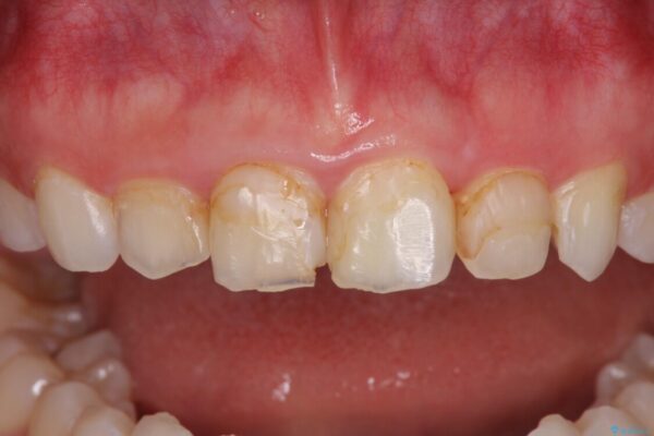 気になる前歯を美しく　マウスピース矯正とセラミッククラウン 治療途中画像