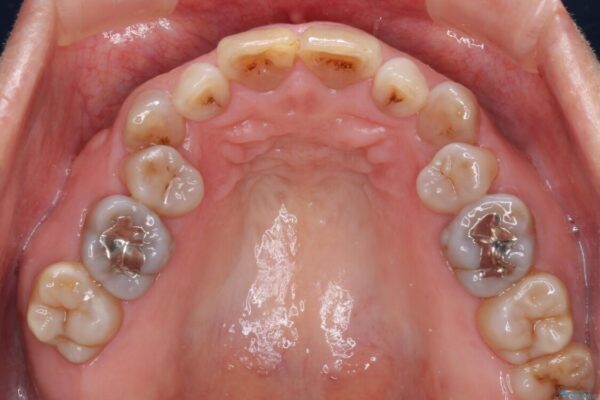 矯正の後戻りと変色歯を治したい　総合歯科診療 治療前画像
